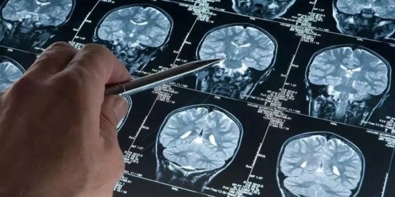 Bilim dünyası şokta: En genç Alzheimer vakası teşhis edildi