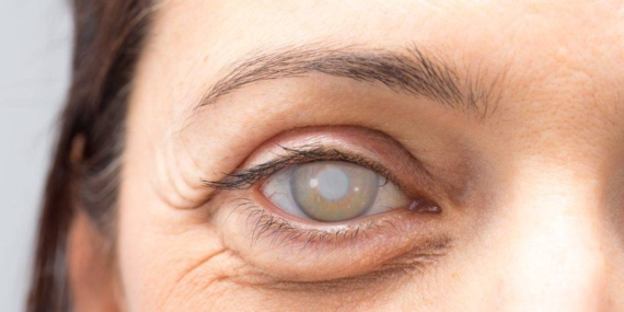 Tavuk Karası Hastalığı Tedavisi